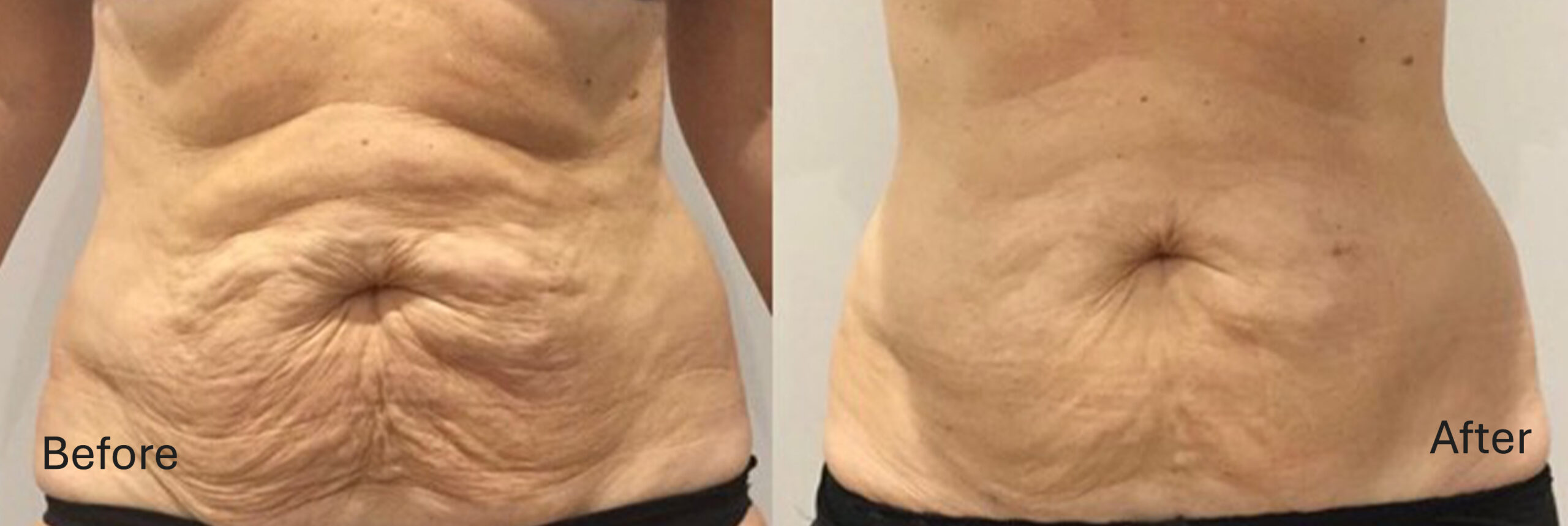 Stretch Marks Stretch Marks